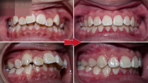 补牙与戴假牙有什么区别,年轻人戴假牙(图1)